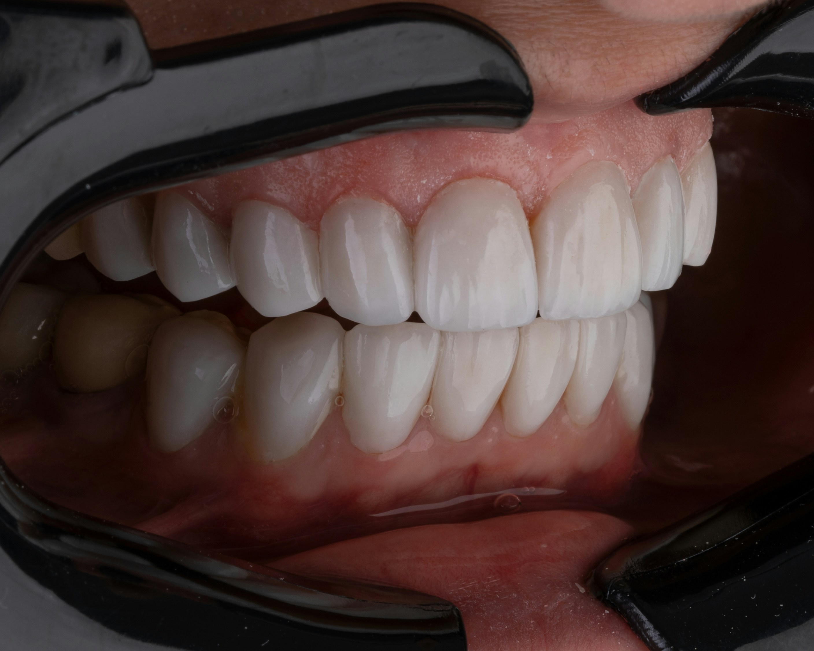 Lentes de Contato Dental